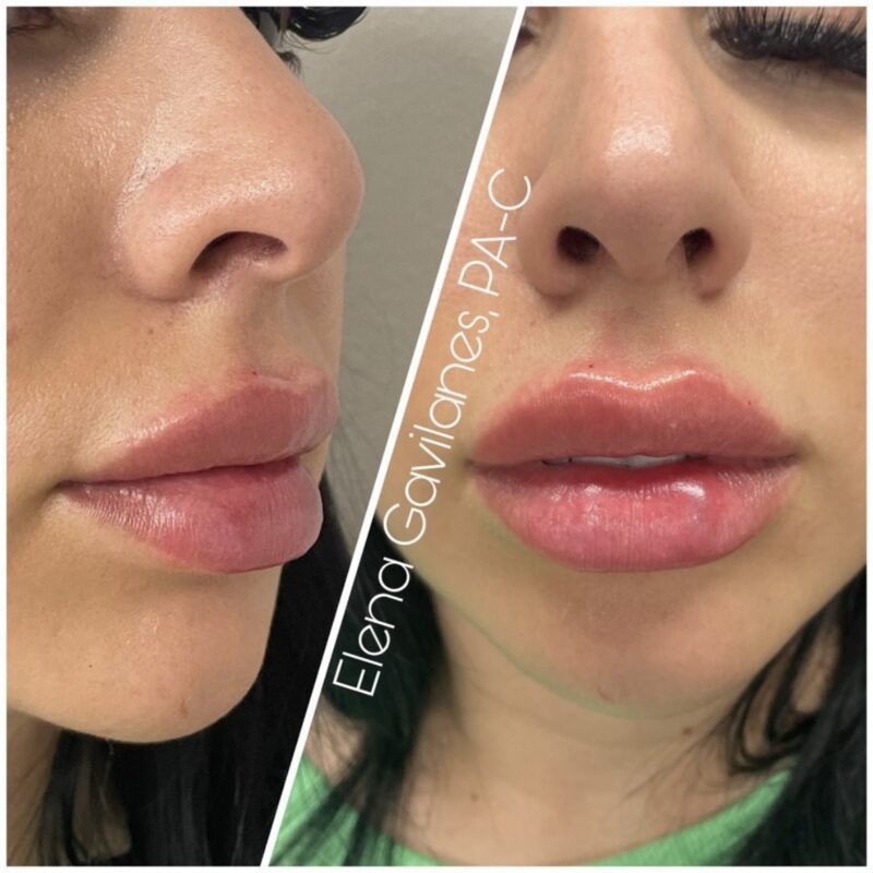 Lip injections with Juvederm Ultra XC in Newport Beach