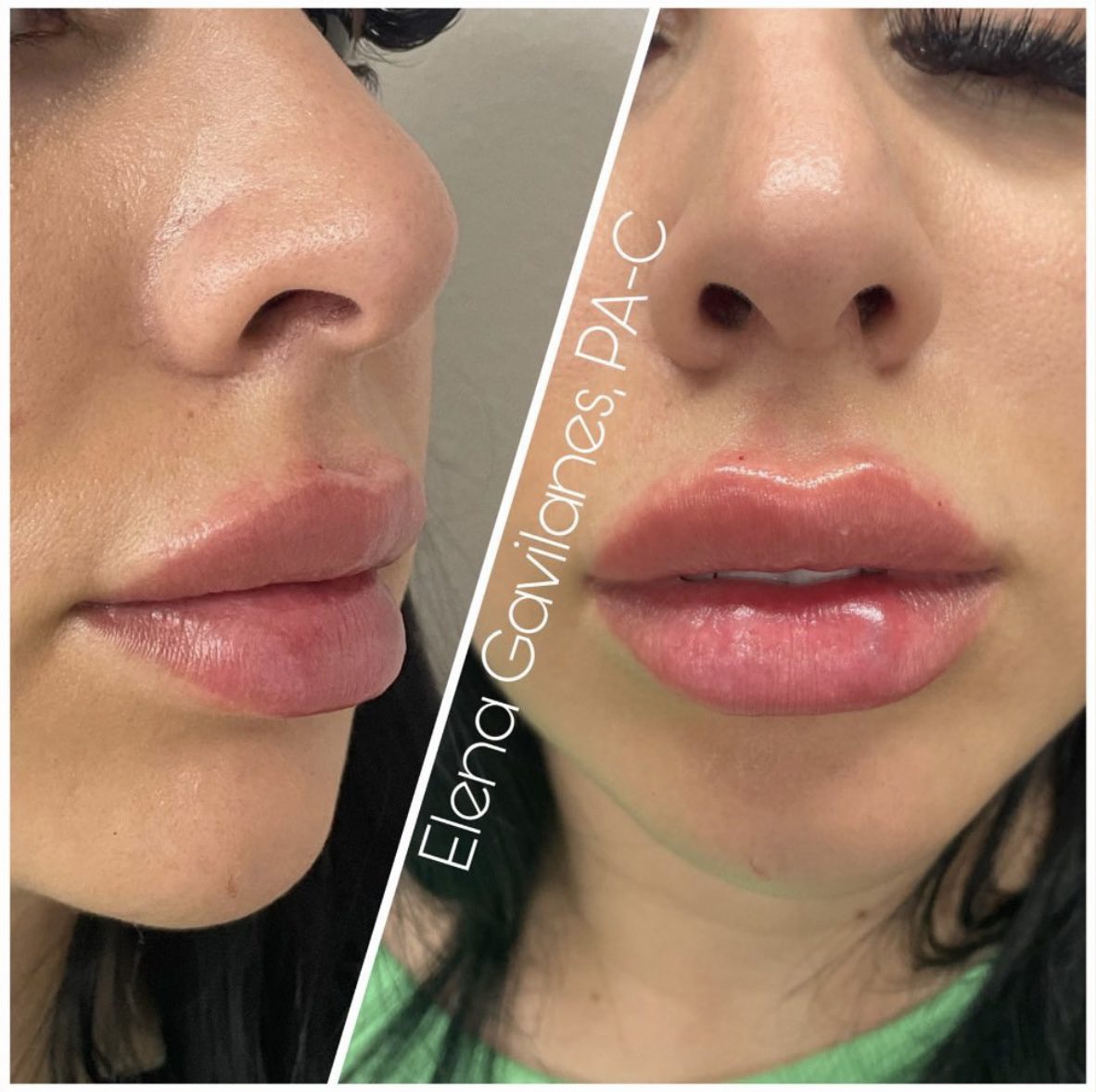 Best Orange County Lip Injections