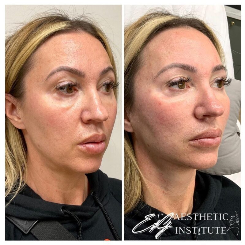 Fillers Injections Newport Beach