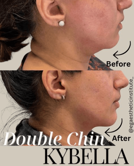 Kybella Injections Newport Beach