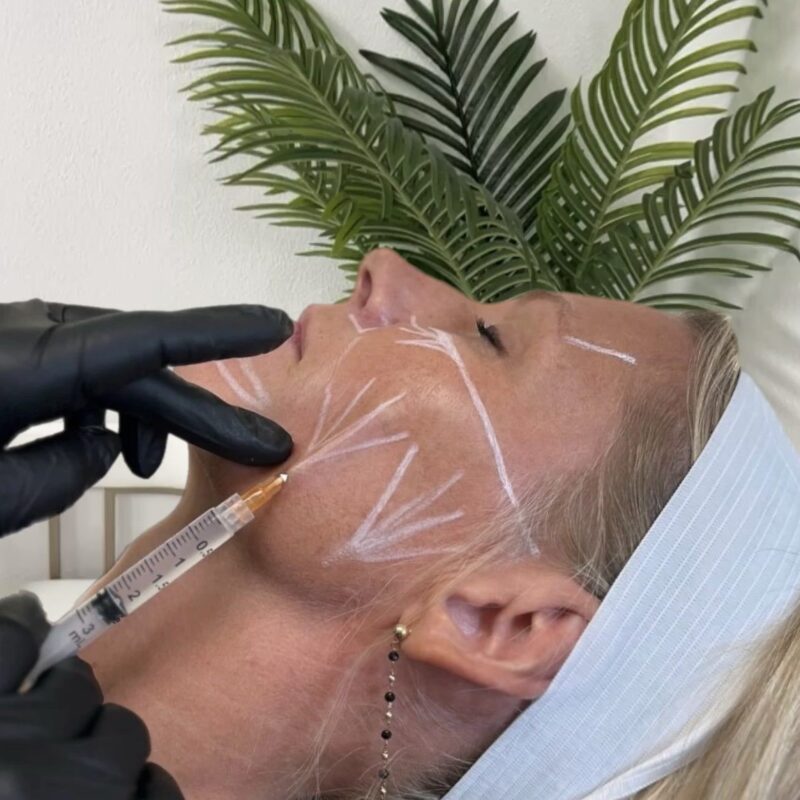 Photo of Sculptra in Newport Beach