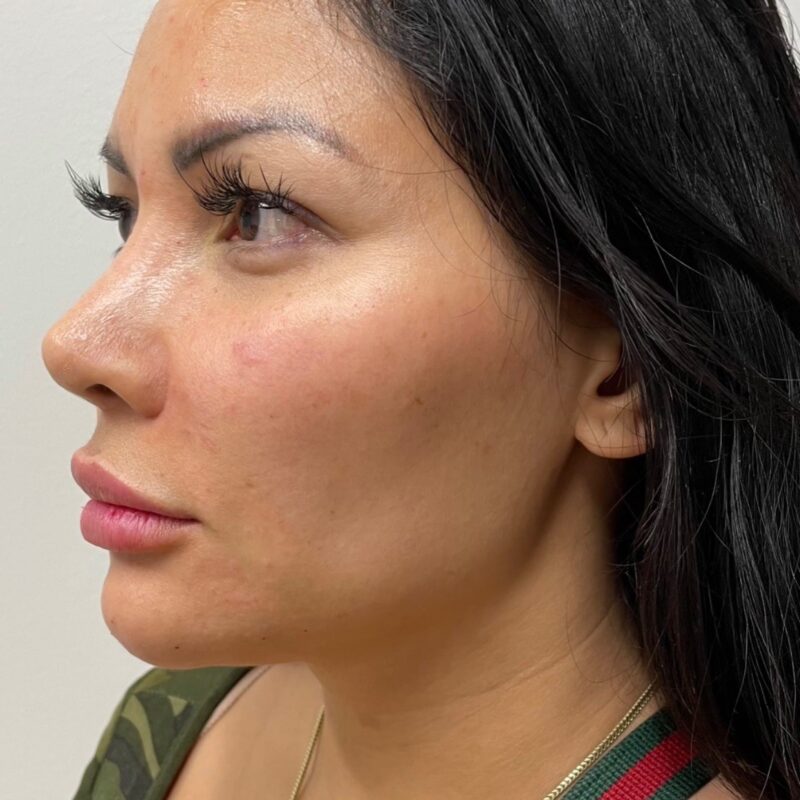 Image-attractive female with cheek filler in Newport Beach