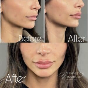 lip filler injections Newport Beach after lip filler dissolving