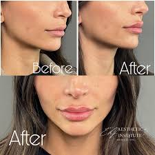 Lip Fillers Newport Beach | Best Lip Augmentation in Newport Beach | E&G Aesthetic Institute 1 Lip Injections in Newport Beach - lip filler before and after