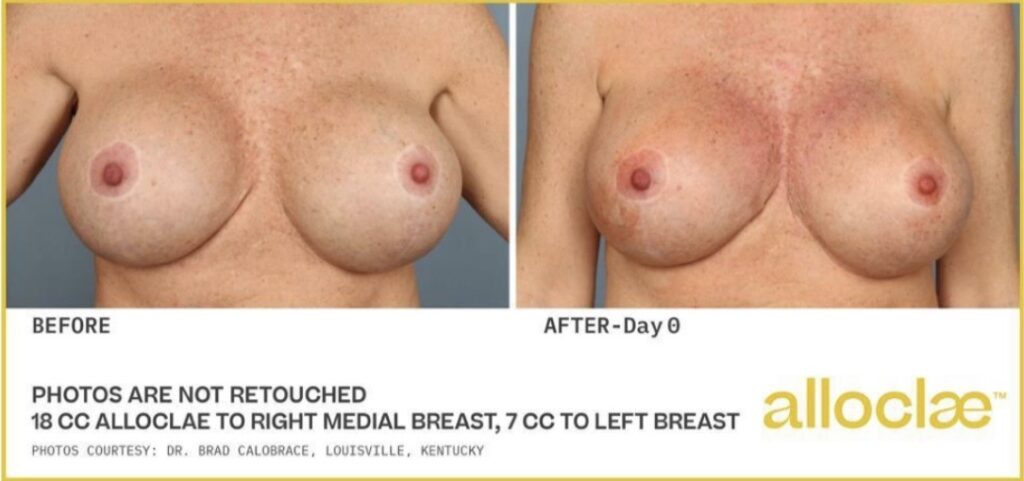 AlloClae Breast Before and After Newport Beach AlloClae Breast Before and After Newport Beach