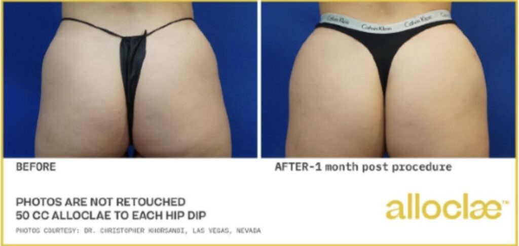 AlloClae Hip Dips Before and After Newport Beach AlloClae Hip Dips Before and After Newport Beach