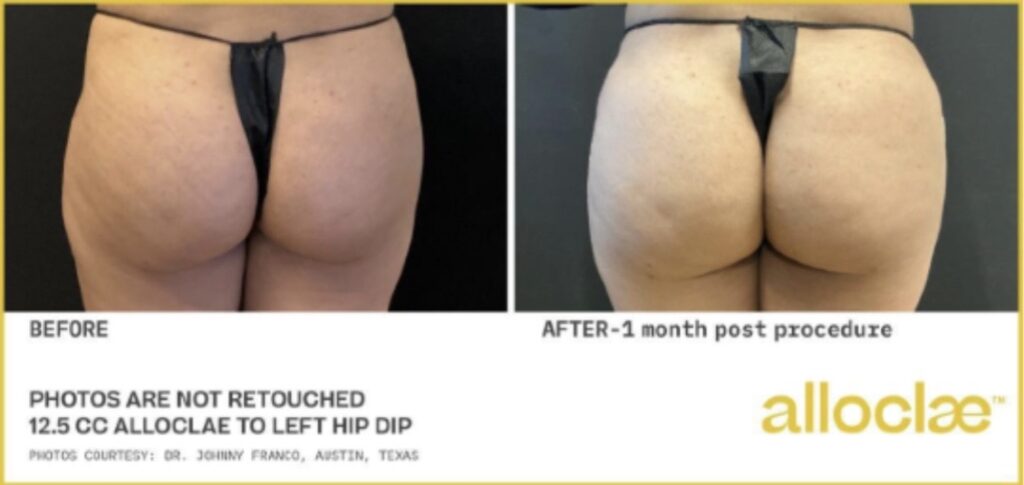 AlloClae BBL before and after newport beach AlloClae BBL before and after newport beach